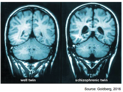 schizophrenia brain ventricles